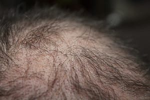 hair loss